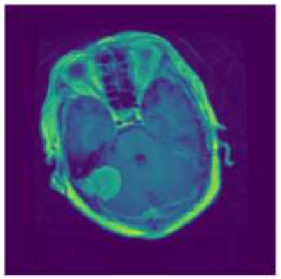 Employing Xception convolutional neural network through high-precision MRI analysis for brain tumor diagnosis